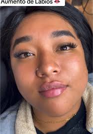 Aumento de Labios con Acido Hialuronico 💉❤️ Eyas SPA  #labiosacidohialuronico #acidoenlabios #russianlips #labiosrusos  #rellenosfaciales #rellenoacidohialurónico