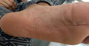 The symptoms of syphilis are not always obvious and may eventually disappear, but you'll usually remain. Importance Of The Dentist And The Auxiliary Oral Health Team In The Diagnosis Of Syphilis