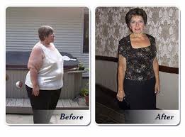 Gastric Bypass Surgery Facts My Bariatric Life Surgery Facts Gastric Bypass Gastric Bypass Results