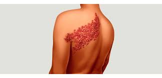 Maybe you would like to learn more about one of these? Extract Objector Clockwise Ù…Ø§ Ù‡Ùˆ Ù…Ø±Ø¶ Ø§Ù„Ø­Ø²Ø§Ù… Ø§Ù„Ø§Ø­Ù…Ø± Oazis Kiten Com