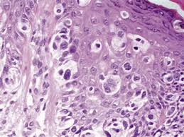 Is a specific histologic type of in situ melanoma. Histologic Criteria For Diagnosing Primary Cutaneous Malignant Melanoma Modern Pathology