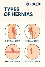 Image result for stomach hernia symptoms