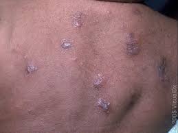Image result for scabies human bites