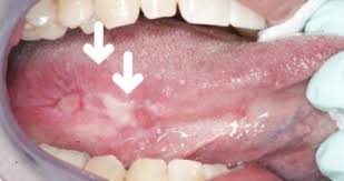 Image result for white cancer on tongue)