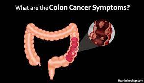 It can be caused by many reasons. Colon Cancer Symptoms And Stages In Males Females