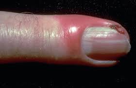 Melanoma skin cancer is the 5th most common cancer in the uk. 12 Nail Changes A Dermatologist Should Examine