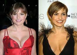 Maybe you would like to learn more about one of these? Celebrity Plastic Surgery Before After Pictures Mariska Hargitay Plastic Surgery Before And After