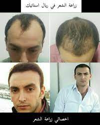 زراعة الشعر في تركيا