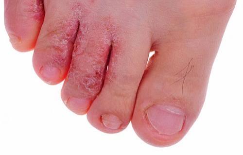 Cách trị nấm chân, nước ăn chân cực hiệu quả khi đi mưa thường xuyên