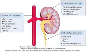 Image result for Postrenal Failure