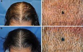 Also a well known laser pioneer named over macho grande teaches you how to build your own helmet. 7 Things You Should Know Before You Buy A Laser Helmet Cap Or Comb