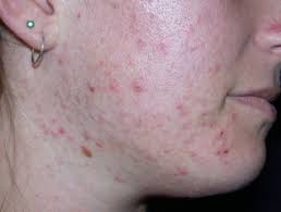 Acne or pimples occur when the pores of the skin become clogged with oil and dirt. Acne Vulgaris Dermnet Nz
