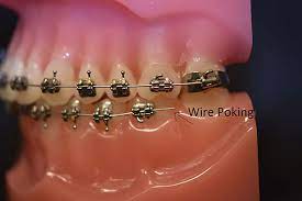 Do not try this without an adult. Ortho Care From Home Sayre Orthodontics Bozeman Mt