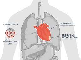 Pericardial mesothelioma grows between two membranes that encase the heart. Pericardial Mesothelioma Cancer Life Expectancy Survival Rate By Stages Cardiac Mesothelioma Mesothelioma 2020