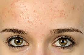 Wash your face twice daily with soap or facewash that you prefer to use and try to clean your face with lukewarm water to remove excess dirt, sweat, and oil on your face. Forehead Acne And Pimples Causes Treatment And Prevention