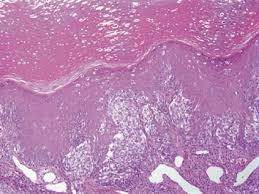 However, lesions on the face can be difficult to interpret, for more information please refer to the related chapter on melanoma: Histologic Criteria For Diagnosing Primary Cutaneous Malignant Melanoma Modern Pathology