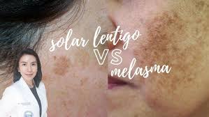 Image result for Solar Lentigo