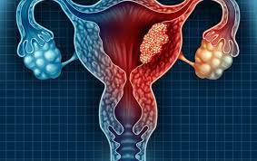 طريقة جديدة أسرع وأدق وأقل كلفة لاكتشاف سرطان عنق الرحم للع لم