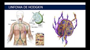 Se o linfoma de hodgkin for detetado precocemente a doença tem cura, principalmente nos estágios 1 e 2 ou quando não estão presentes fatores de risco. Linfoma De Hodgkin Seminario Online De La Semoh 2018 26 06 2018 Youtube