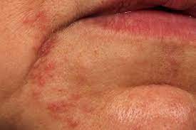 There may be redness and small bumps around the mouth. Perioral Dermatitis Causes Symptoms Treatment And Pictures
