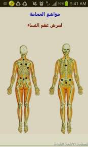 روحانيات فوائد الحجامة لعلاج العقم للنساء 1 تنشيط الغدة فيسبوك
