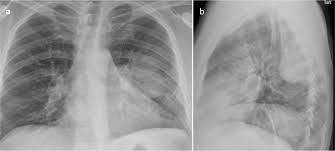 Loculated effusion (shown in the images below) is characterized by an absence of a shift with a change in this case of loculated pleural effusion (e), the configuration of the fluid suggests a free. Epos Trade