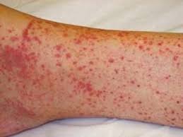 It has been recognized a subset of patients with a sudden worsening of acne, often during treatment with oral isotretinoin, but without the strong presence of systemic involvement. Purpura Fulminans Uptodate