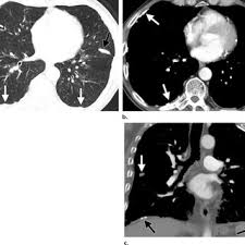 Department of radiology, university of british. Asbestos Related Pleural Plaques Involving A Fissure And The Posterior Download Scientific Diagram