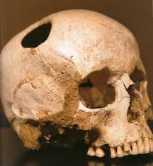 Image result for Skull Trephination