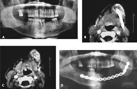 Image result for Chondrosarcoma