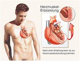 Myocarditis is a disease marked by the inflammation of heart muscle. Myokarditis Herzmuskelentzundung Ursachen Diagnostik Therapie