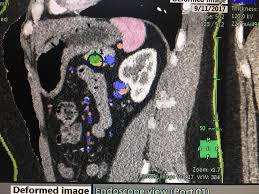 It's important to weigh the benefits of each treatment option against the possible risks and side effects. New Guideline Clarifies Role Of Radiation Therapy In Pancreatic Cancer Treatment Imaging Technology News