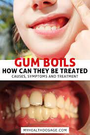 Gum Boils What They Are And How To Treat Them In 2021 Canker Sore On Gum Mouth Blister Remedy Gum Sores
