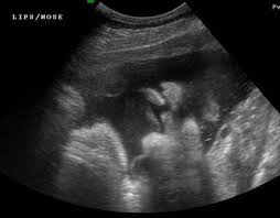 Pin On Ob Gyn Utrasound 301 Mod 4
