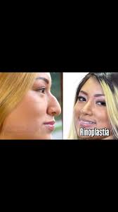 👍MEJORA EL ASPECTO DE TU NARIZ 🥰 ✓La #Rinoplastia es la cirugía facial  más solicitada debido a los excelentes cambios que logra, al finalizar el  proceso operatorio, donde se pude notar una