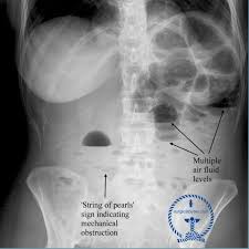 Mechanical Small Bowel Obstruction Small Bowel Obstruction Bowel Obstruction Medical Knowledge