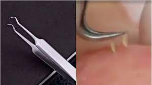 When the jaws require small detail and precise. Skin Experts Weigh In On Blackhead Tweezer Video Teen Vogue
