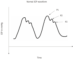 Intracranial Pressure Monitoring Gold Standard And Recent Innovations