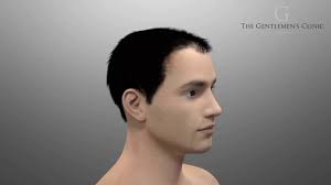 hair transplantation the gentlemen s clinic