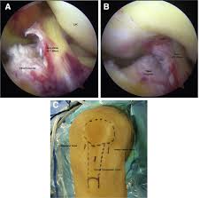 An access control lists acl is a function that watches incoming and outgoing traffic and compares it with a set of defined statements. Primary Repair Of Tibial Sided Avulsion Of The Anterior Cruciate Ligament Sciencedirect