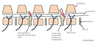 Gelenklehre > joints of spine, thorax and skull > zwischenwirbelsymphyse > bandscheibe > gallertkern. Bandscheibenvorfall Was Passiert Da Eigentlich Nathur De
