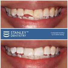 Dental Bonding Dentistry Cosmetic Dentistry Dental Bonding