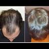 Ahead, dermatologists explain the treatment, how it works, and whether women can use what is minoxidil? 1