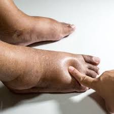 Image result for flegmona pedis)