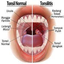( part 01 ) tips memperbanyak tanaman sikas. Cara Rawat Bengkak Tonsil Dengan Supplemen Cantikseri