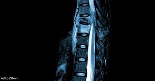 Image result for Spinal Epidural Abscess