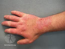 Image result for contact dermatitis