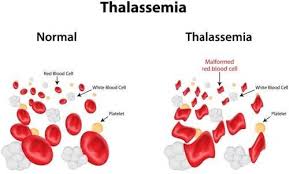 Thalassemia Causes Symptoms And Treatment