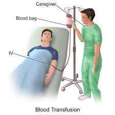 Image result for Transfusion Associated Circulatory Overload