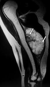 Image result for Chondrosarcoma